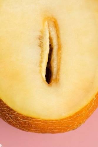 معایب لابیاپلاستی